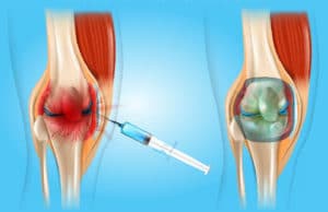 Infiltração do joelho com ácido hialurônico | Dr. Fernando Cury Rezende